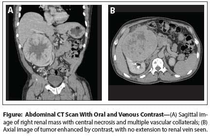 Large Renal Mass: A Challenge for the Urologist