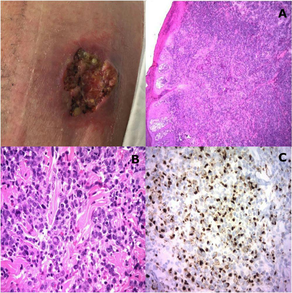 What Caused This Ulcerated Nodular Skin Lesion in a 30-Year-Old Man?