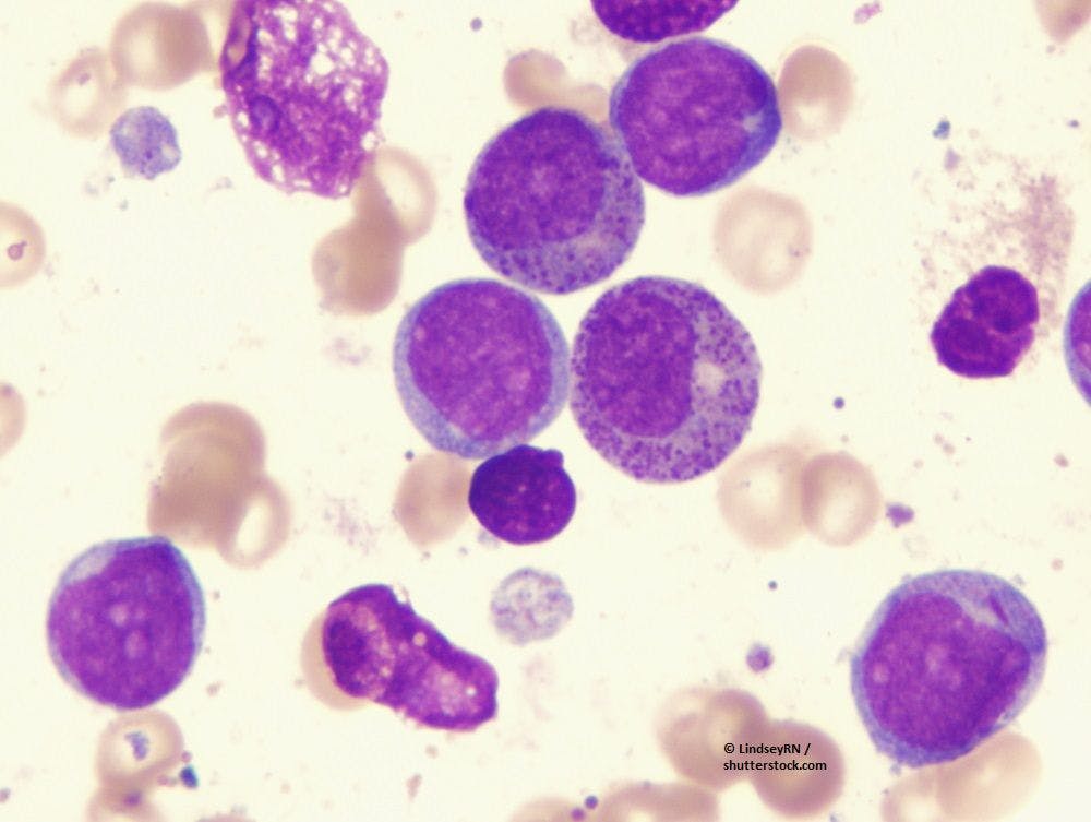 Findings from SELECT-AML-1 support the potential benefit of tamibarotene in those with acute myeloid leukemia harboring RARA gene overexpression.