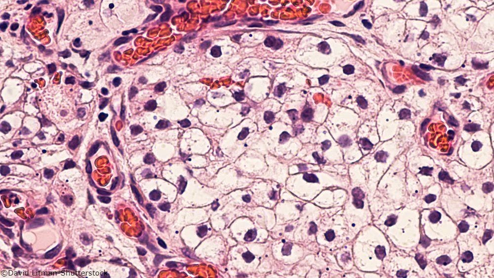 Mutation Profiles May Aid in Treatment of Non–Clear-Cell Renal Cell Carcinoma