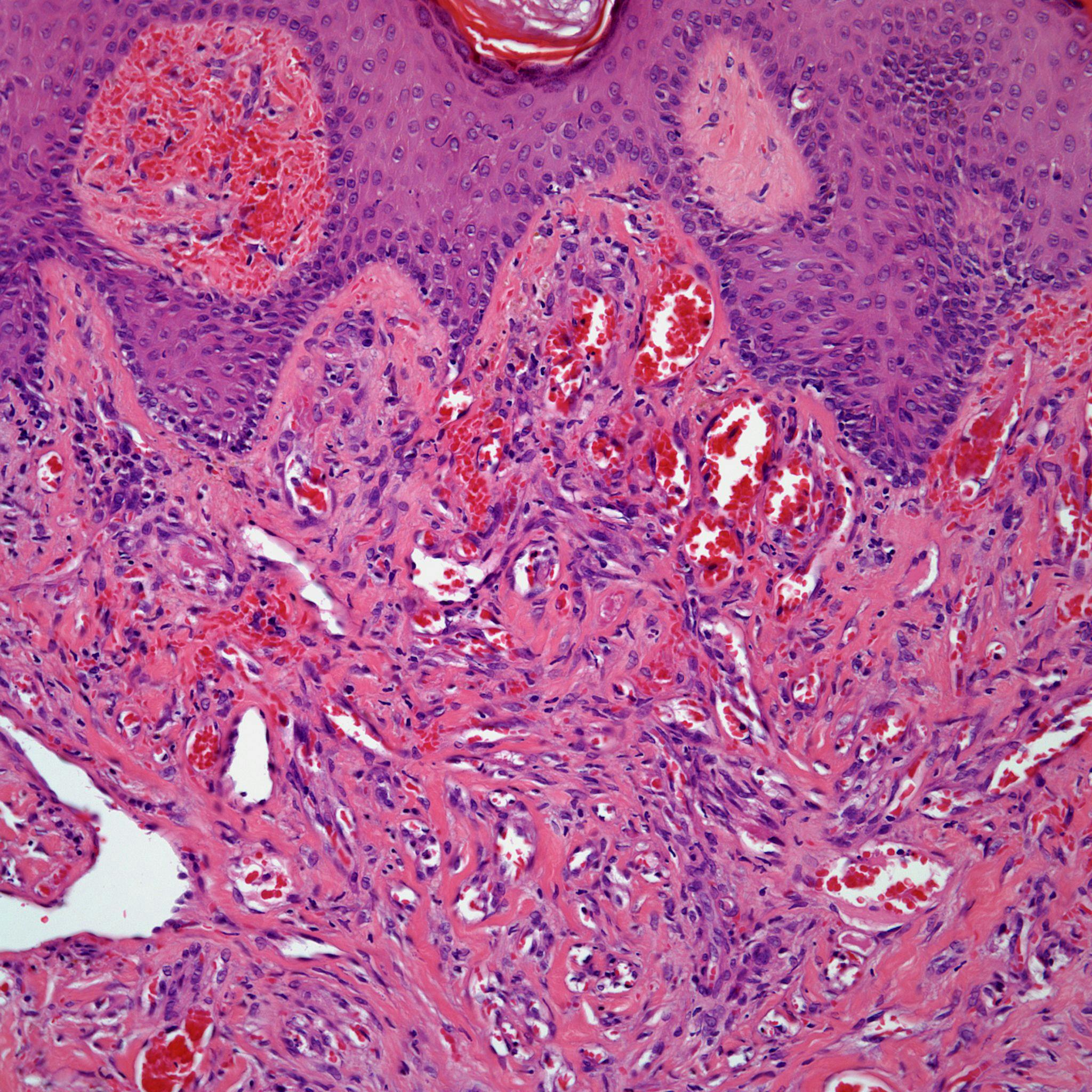 Diagnose This 58-Year-Old Man With Purpuric Nodules