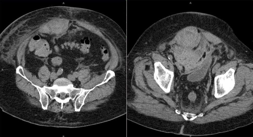 A 60-Year-Old Patient Presents With Acute Abdominal Pain