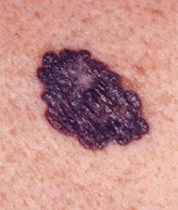 MEK/BRAF Inhibitor Combo Reduces Death by One-Third in Melanoma