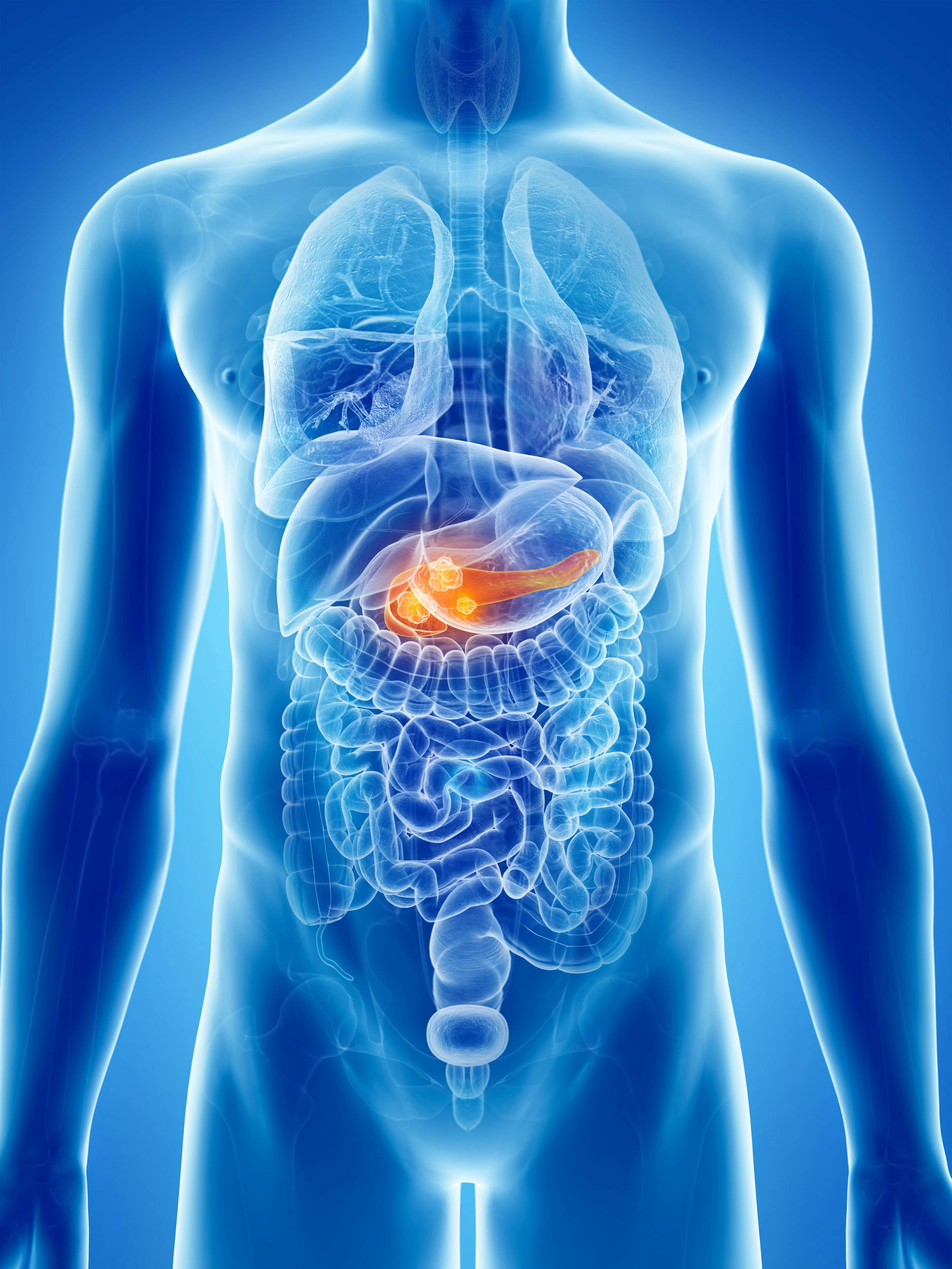 Positive Results Seen in Trial Investigating Nadunolimab Plus Chemotherapy for Advanced Pancreatic Cancer