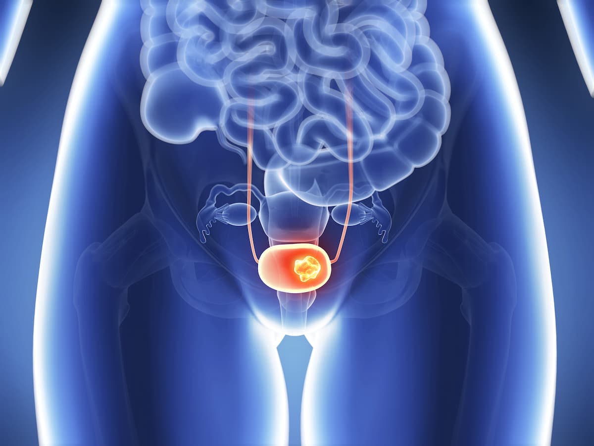 Enfortumab Vedotin Combo Earns Priority Review in Japan for Bladder Cancer | Image Credit: © SciePro - stock.adobe.com.