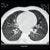 ALA Recommends CT Lung Cancer Screening for High-Risk Individuals