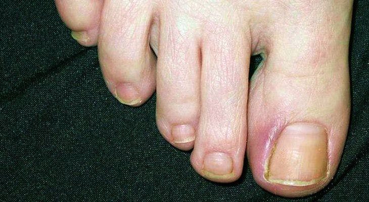 Patient With Supraglottic Squamous Cell Carcinoma Develops Painful Swelling on Both Great Toes