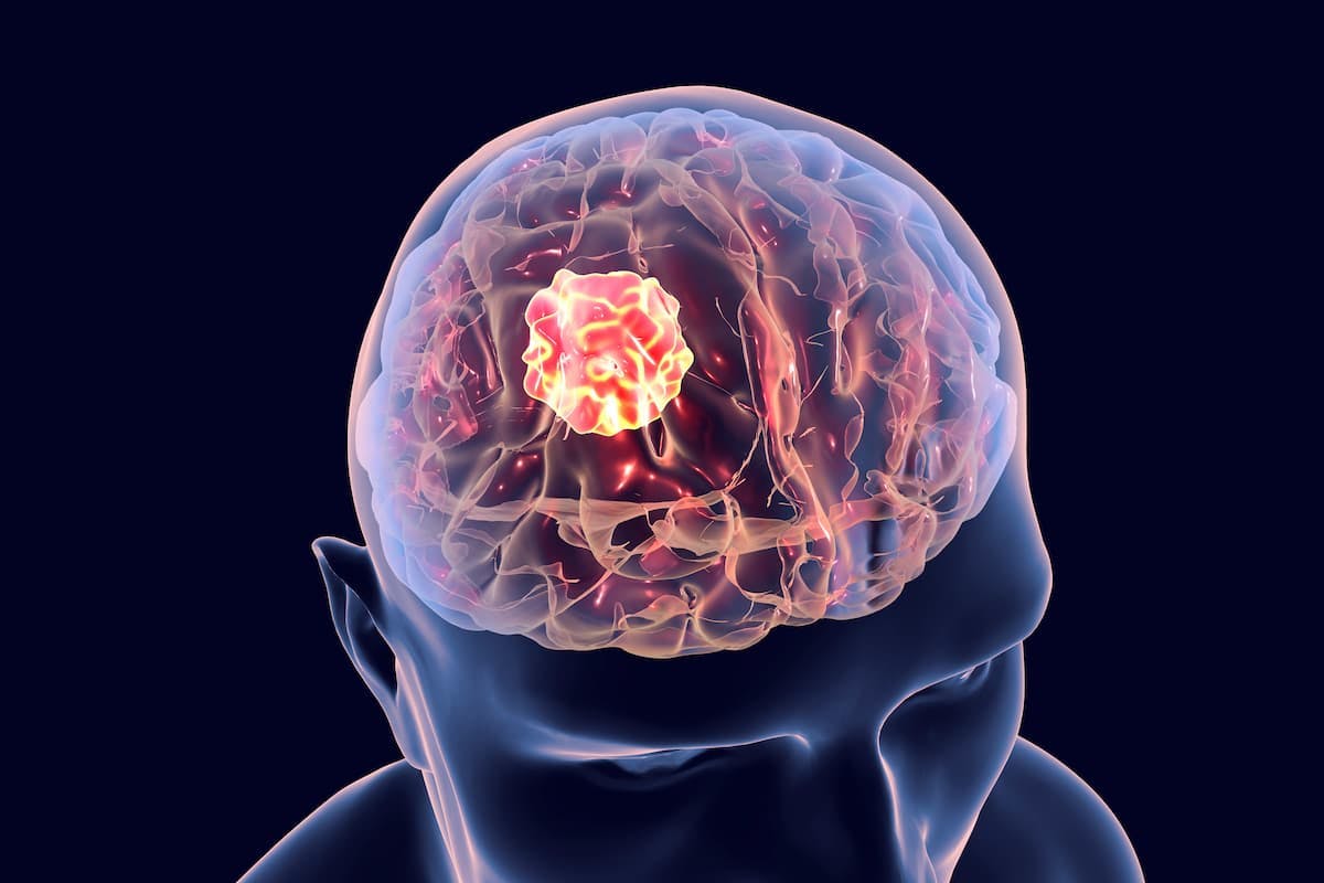 SONALA-001/Transcranial Ultrasound Device Gets FTD in Pediatric Brain Cancer | Image Credit: © Dr_Microbe - stock.adobe.com. 