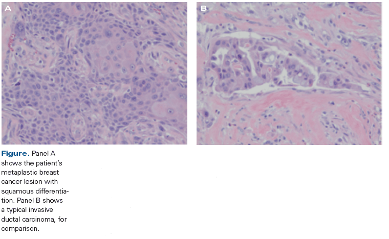 A 40-Year-Old Woman With a New Triple-Negative Breast Mass, Shown on Biopsy to Be Metaplastic Carcinoma