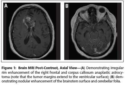 Leptomeningeal Enhancement in a  58-Year-Old Woman