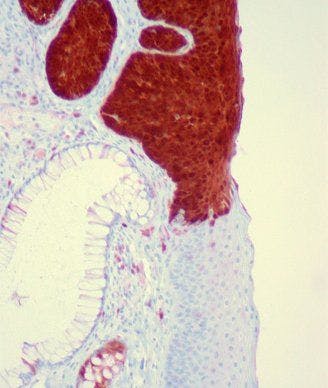 Anal squamous carcinoma in situ, p16 immunostain