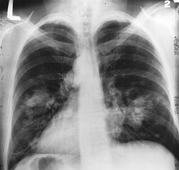 X-ray image of chest with possible lung cancer growth on the left side of the lu