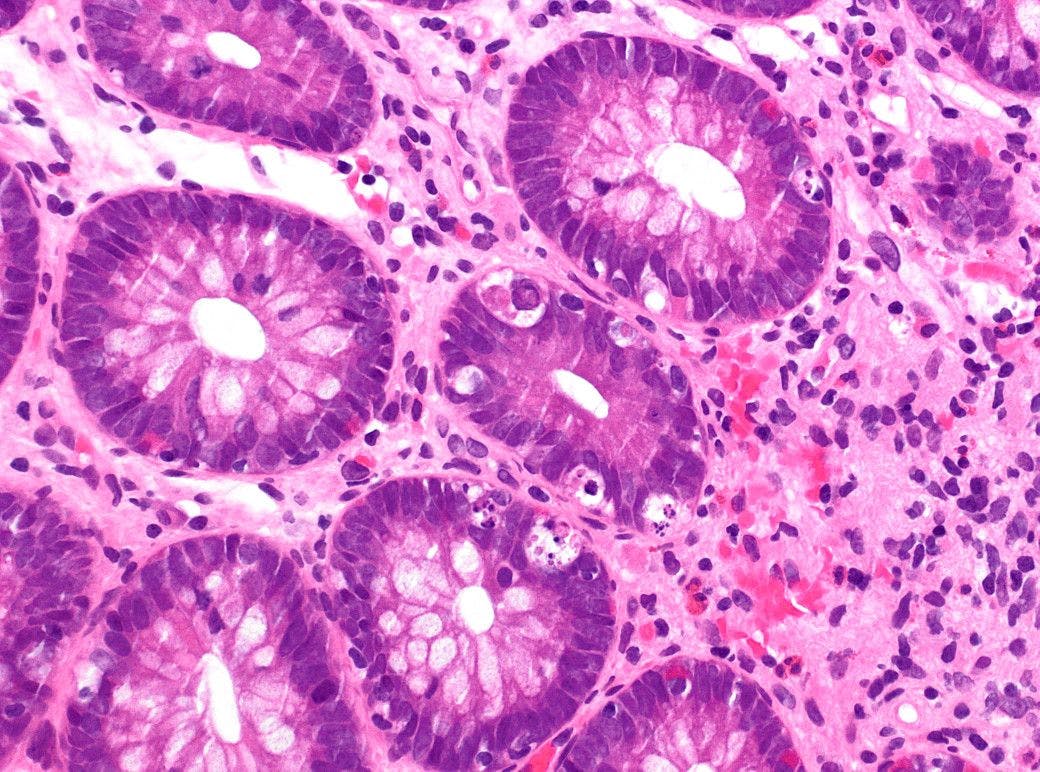 Microscopic image of colonic graft versus host disease