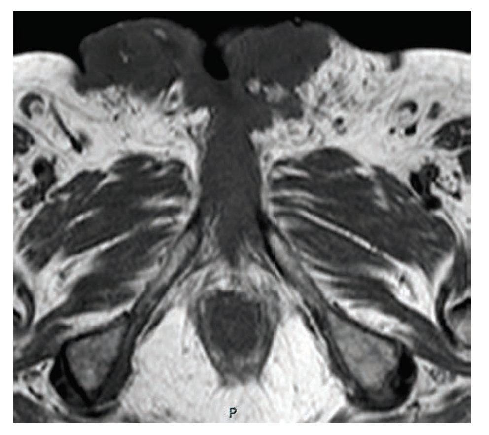 FIGURE 1. MRI of Penile Cancer Showing Early Invasion Into Bone and Destruction of Penile Anatomy