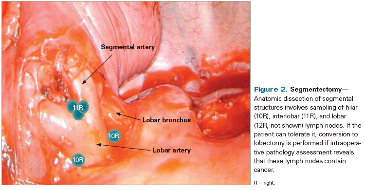 Minimally Invasive Surgery for Early-Stage Lung Cancer: From Innovation to Standard of Care