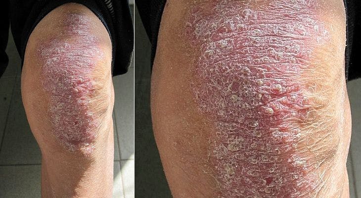 Mildly Pruritic Skin Eruption in 44-Year-Old Taiwanese Immigrant