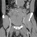 Large Scrotal Mass With Multifocal Intra-Abdominal, Retroperitoneal, and Pelvic Metastases
