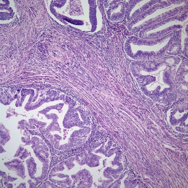 “Further research is needed to investigate new cost-effective treatments that could improve outcomes for patients with newly diagnosed advanced or recurrent [endometrial cancer],” the study authors wrote.