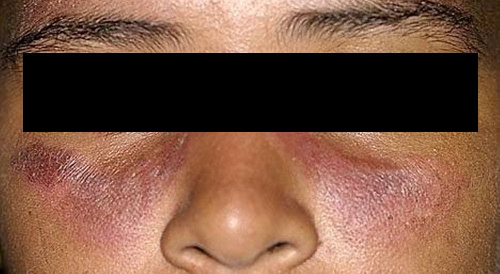 Photosensitive Facial Rash Depicted Along with Polyarticular Arthralgias