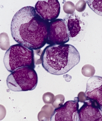 Investigators say that a phase 1/2 trial evaluating MGTA-117 in 2 hematologic malignancies has been paused after observing a serious adverse effect that may be related to the agent.