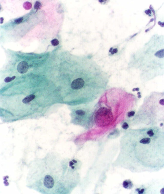 Pap test showing an atypical cell