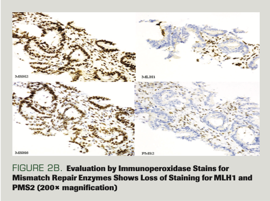 FIGURE 2B. Evaluation by Immunoperoxidase Stains for Mismatch Repair Enzymes Shows Loss of Staining for MLH1 and PMS2 (200× magnification)