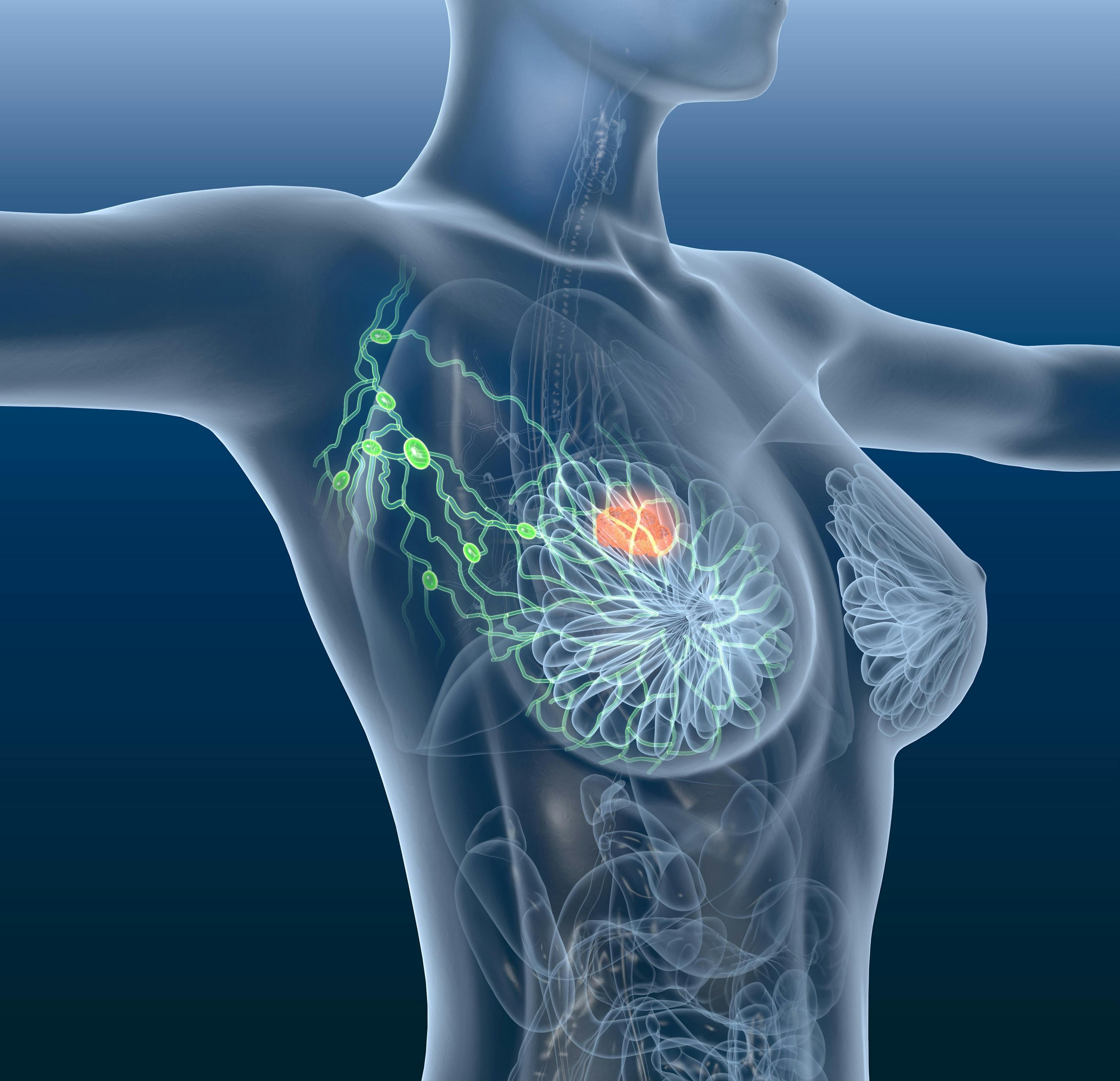 Poor Health-Related Quality of Life May be Associated With Increased Mortality Among Breast Cancer Survivors 