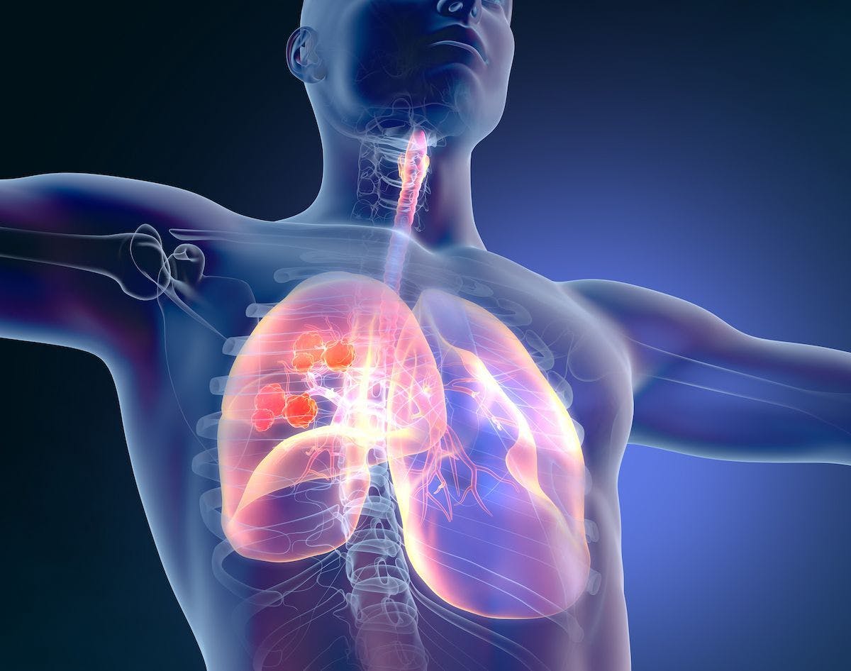 Treatment with adagrasib appears to be particularly well tolerated in patients with KRAS G12C–mutated non–small cell lung cancer who receive it for more than 1 year.
