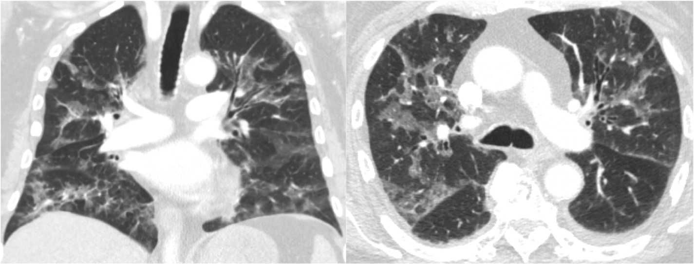 Pneumocystis jirovecii Pneumonia in Patients With Metastatic Prostate Cancer on Corticosteroids for Malignant Spinal Cord Compression: Two Case Reports and a Guideline Review