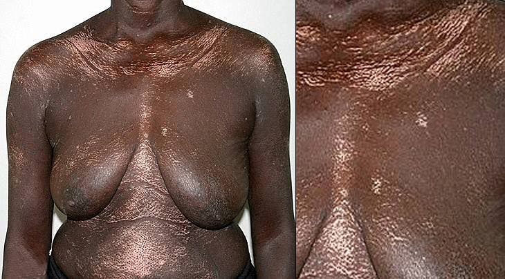 A 49-Year-Old Woman Develops Thickened and Bound-Down Skin