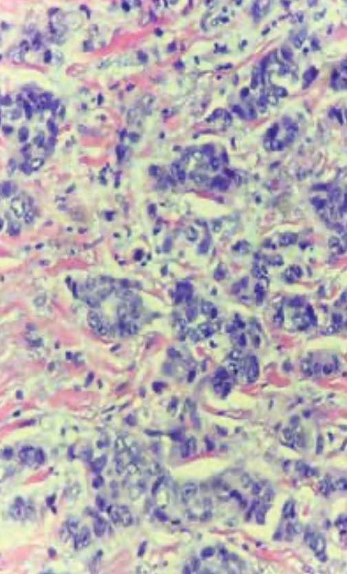 FIGURE 3. 40x H&E, scattered mitotic figures with marked pleomorphic cells lacking gland formation constituting grade 3 ductal carcinoma.