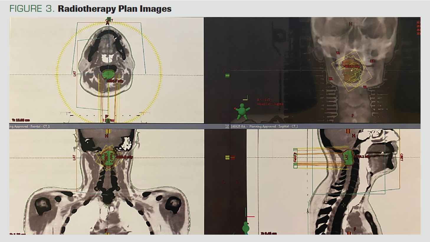FIGURE 3. Radiotherapy Plan Images