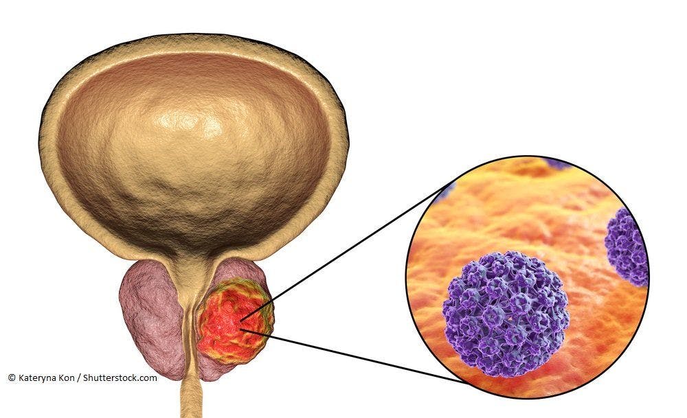 Nuclear Pore Proteins May Be Effective Anti-Cancer Targets for Prostate Cancer