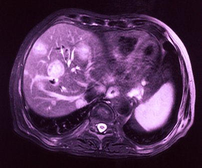 MRI of liver cancer