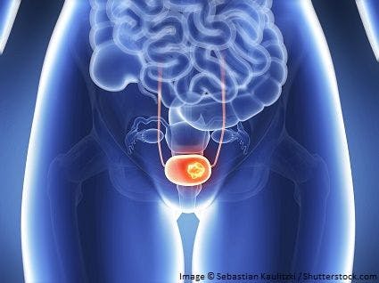 Long-term data show continued benefit with pembrolizumab monotherapy for bladder cancer subset