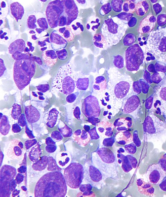 Acceptance of an investigational new drug application for GRC 54276 will allow investigators to proceed with a phase 1/2 trial evaluating the agent in patients with advanced solid tumors and lymphomas.
