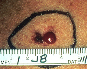 Advanced malignant melanoma