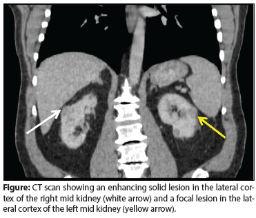 Renal Cancer Management in a Patient With Chronic Kidney Disease   