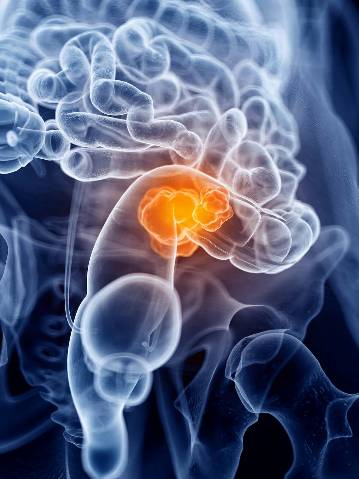 According to findings from a biomarker analysis of the phase 2 TheraP trial, mean standardized uptake value of PSMA-PET predicted favorable responses to 177Lu-PSMA-617 compared with cabazitaxel in patients with metastatic castration-resistant prostate cancer.