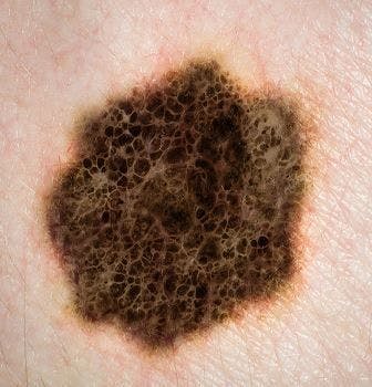 MEDI4736 for Melanoma Appears to Be Safe With Durable Clinical Activity