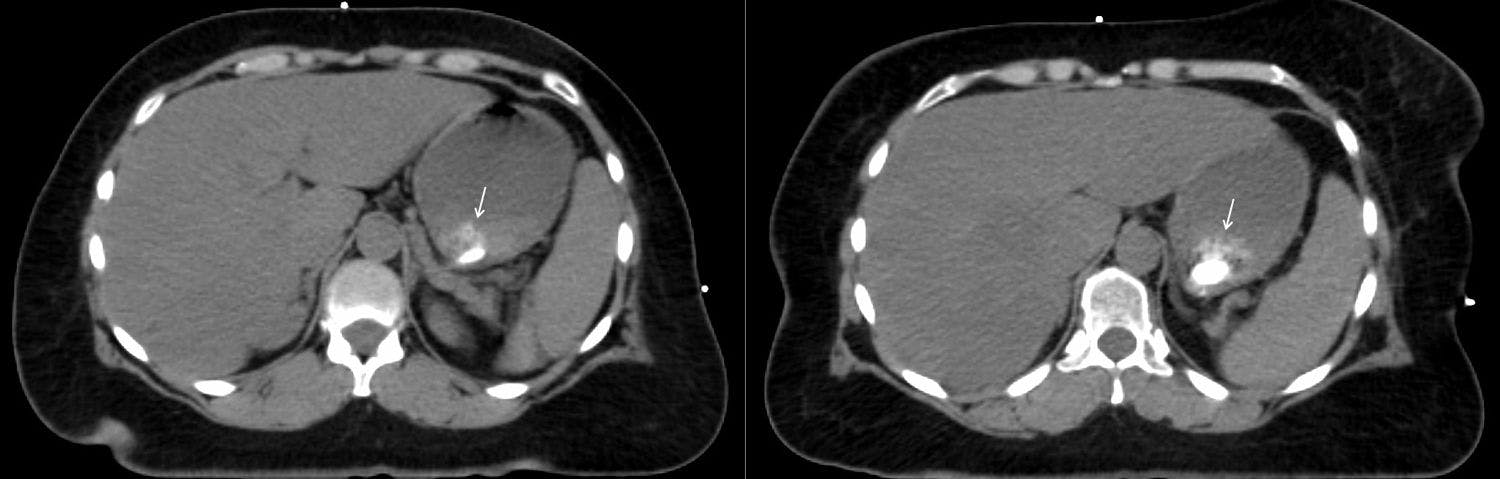 CT Abnormality in Patient With Stage II Breast Cancer History