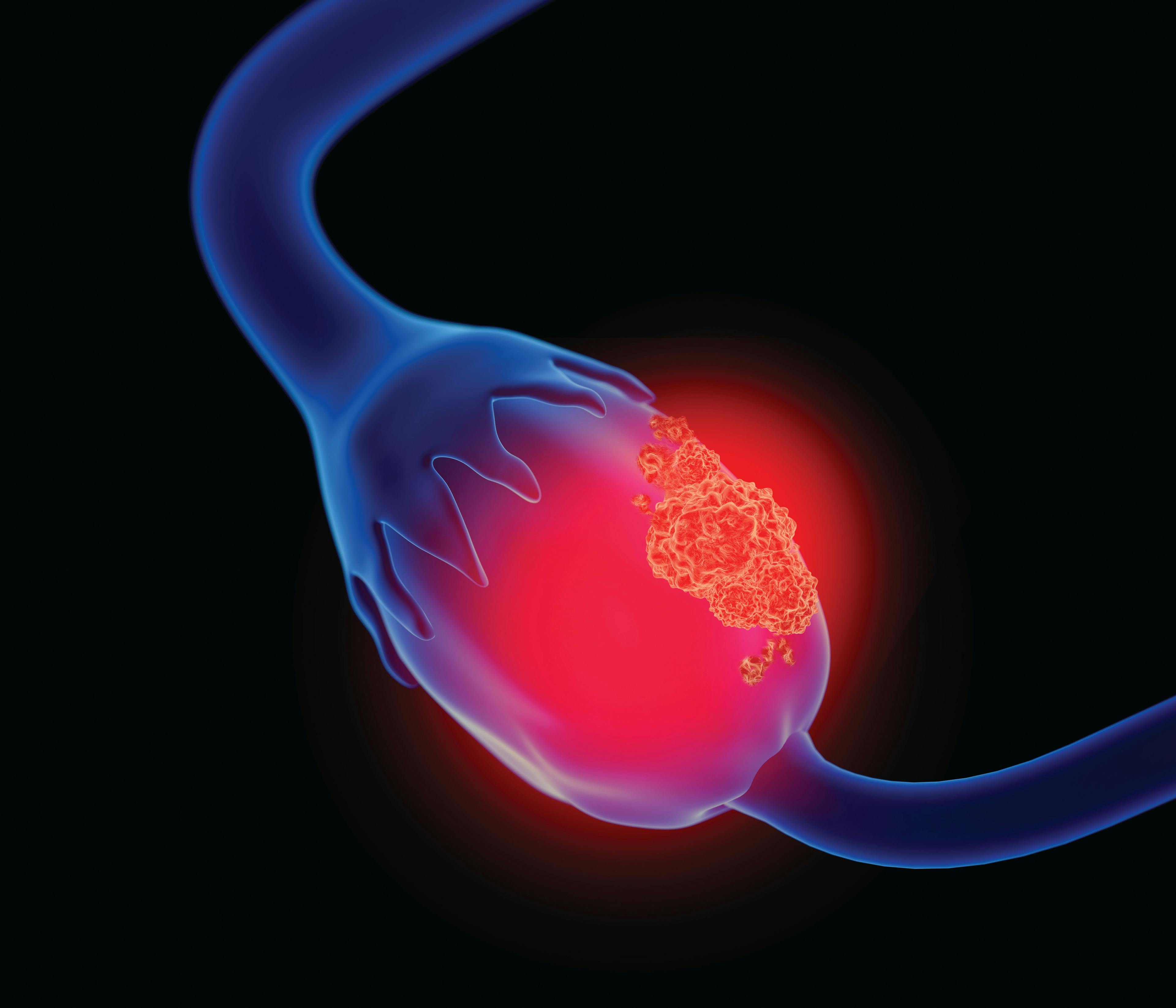 Patients with platinum-resistant ovarian cancer may benefit from treatment with ofranergene obadenovec, which received fast track designation from the FDA. 