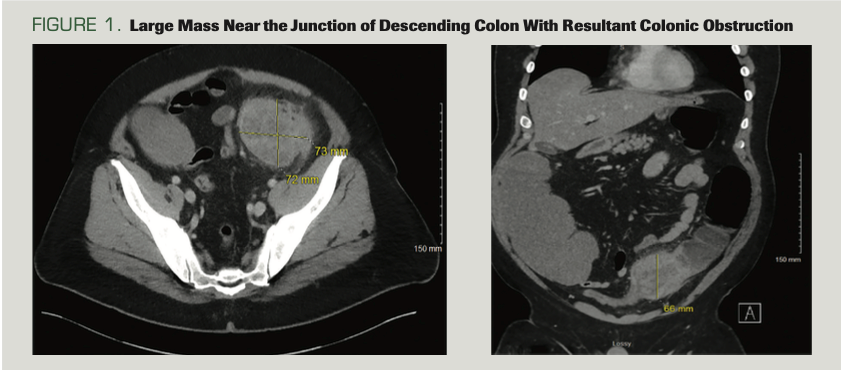 FIGURE 1. Large Mass Near the Junction of Descending Colon With Resultant Colonic Obstruction