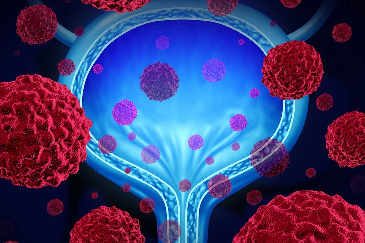 Adding the investigational oral drug BXCL701 to pembrolizumab appears effective in small cell neuroendocrine metastatic castration-resistant prostate cancer, a rare and aggressive disease.