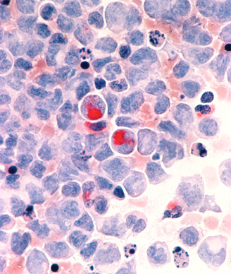 Call for New Treatment Approaches in Acute Myeloid Leukemia