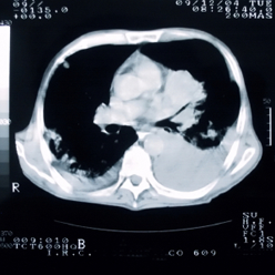 Lung cancer on CT scan