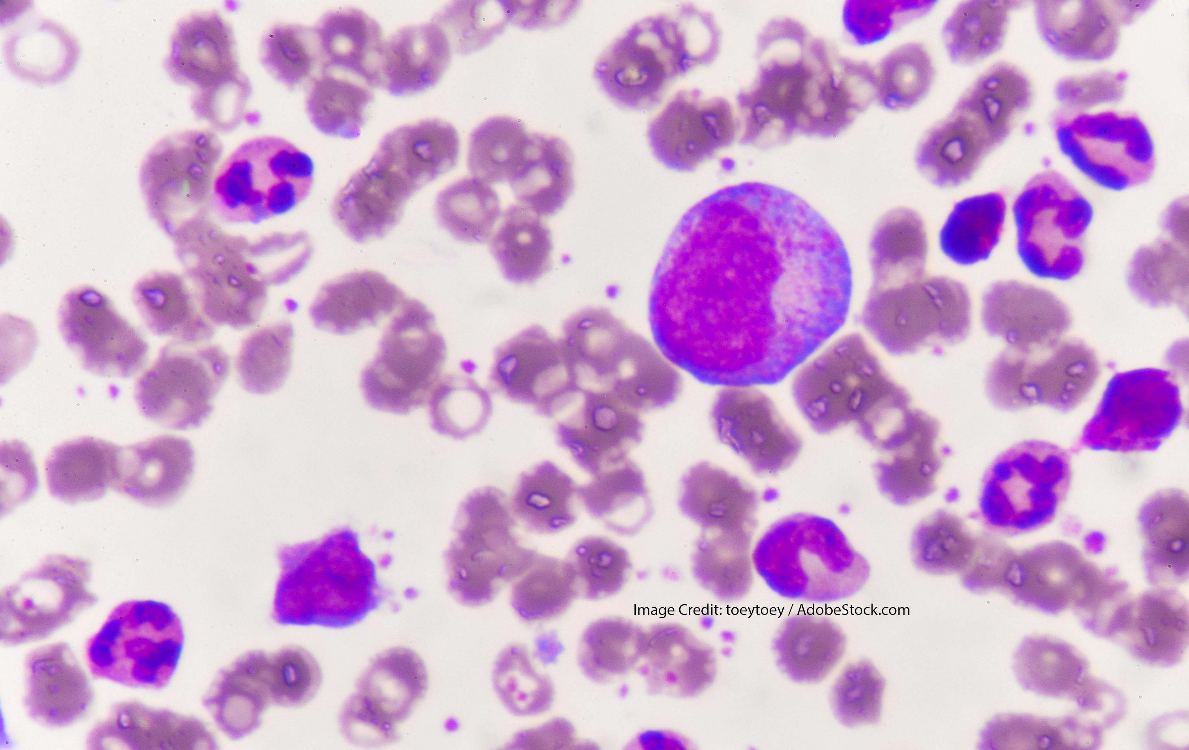 Acute Myeloid Leukemia and EVI1 (MECOM)