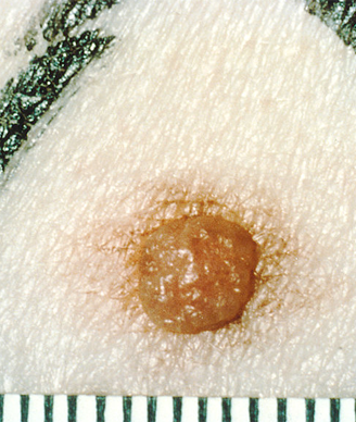 New Melanomas Difficult to Detect in Patients Treated With BRAF Inhibitors