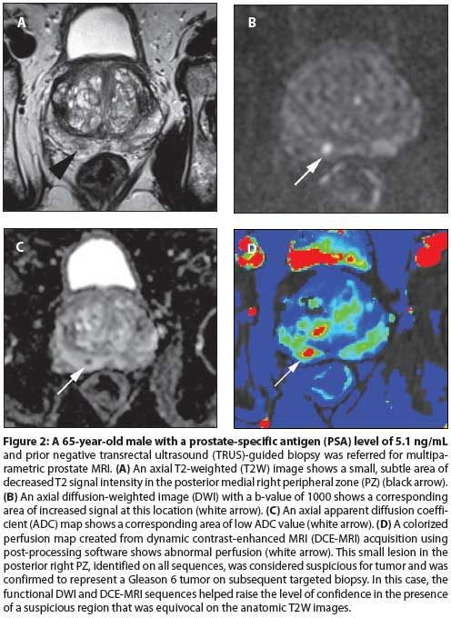 The State of Prostate MRI in 2013