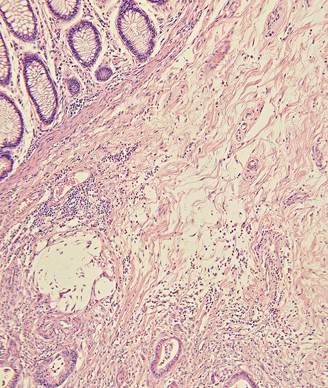 Micrograph of a colon cancer